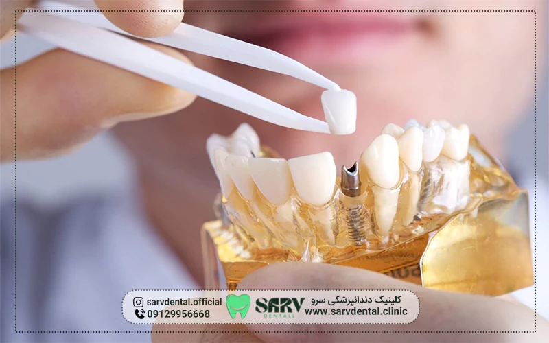 ایمپلنت دندان برای چه کسانی مناسب نیست؟