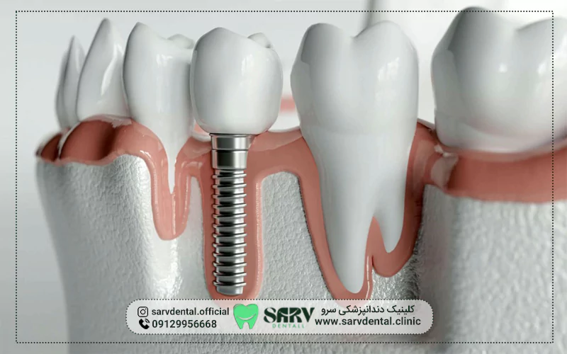 چرا ریشه دندان باید قبل از ایمپلنت برداشته شود؟