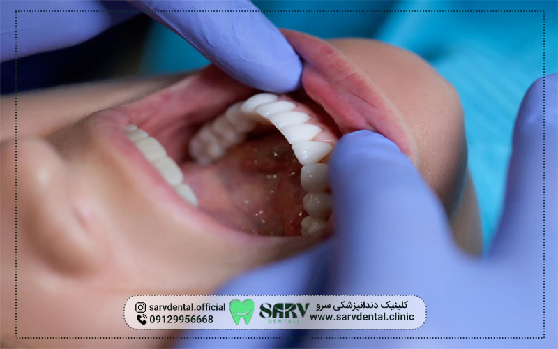 مزایای لمینت کردن دندان‌ خراب