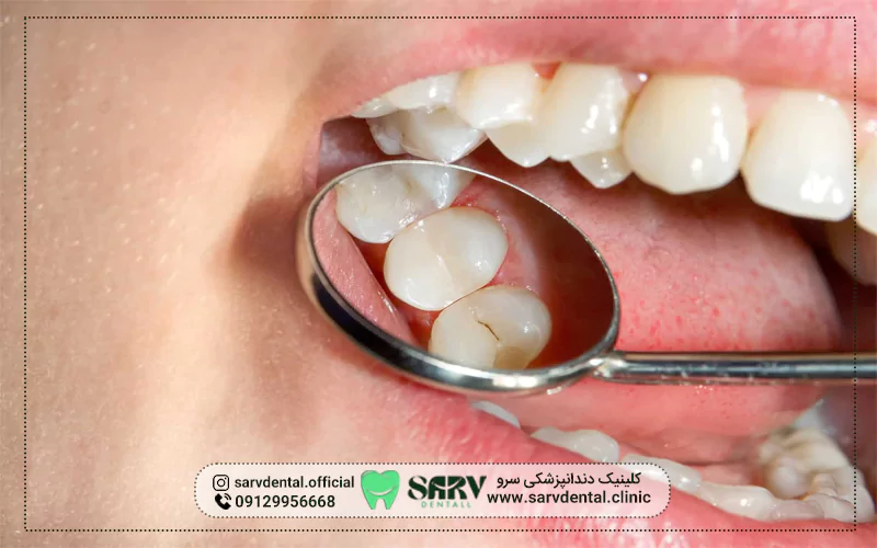چگونه از لمینت دندان مراقبت کنیم؟