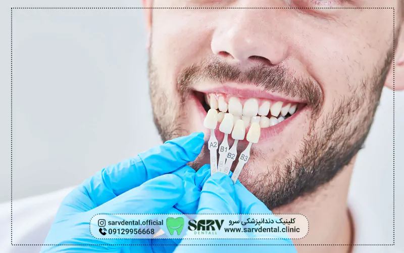لمینت دندان چیست؟