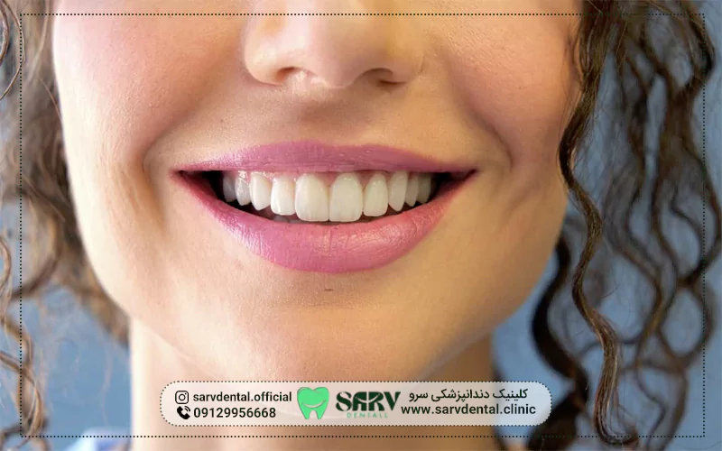 لمینت دندان باعث بوی بد دهان می‌شود؟