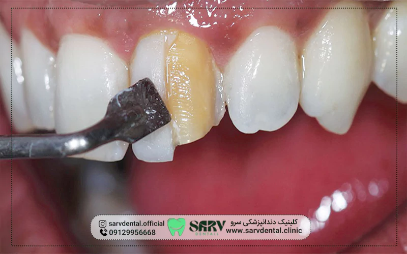 دلایل پوسیدگی دندان بعد از کامپوزیت