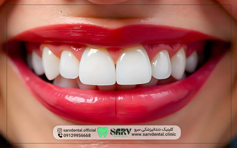 آیا کامپوزیت برای همه مناسب است؟