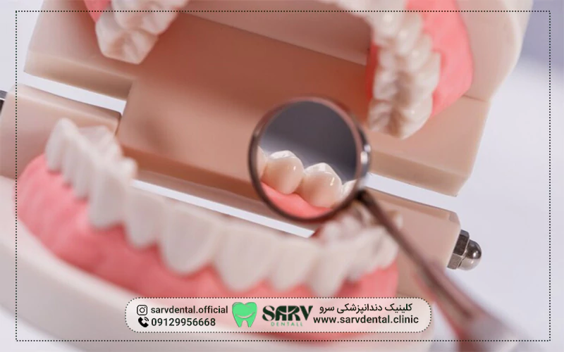 قیمت کامپوزیت دندان