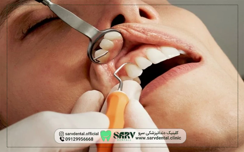 آیا خدمات کامپوزیت دندان تحت پوشش بیمه‌های تکمیلی است؟