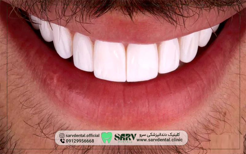 مزایای بلیچینگ دندان