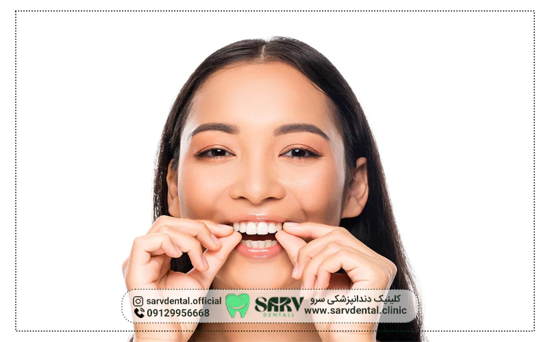 کامپوزیت متحرک دندان یا Snap On Smile چیست؟