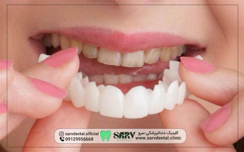 مزایای کامپوزیت متحرک دندان کدامند؟