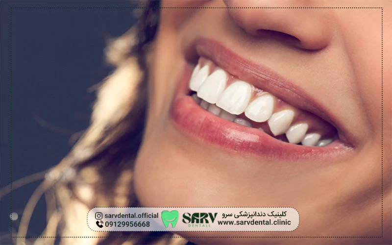 چرا از خمیر دندان مخصوص برای دندان کامپوزیت استفاده کنیم؟