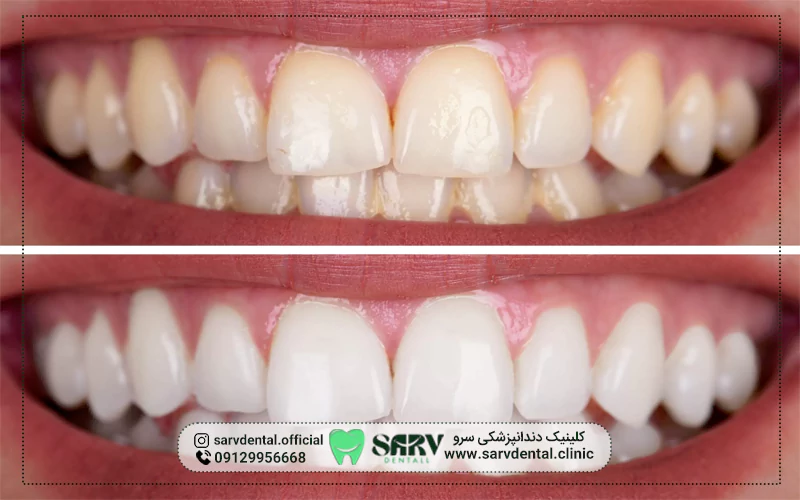 جمع بندی در مورد چگونه دندان های کامپوزیت شده را سفید کنیم؟