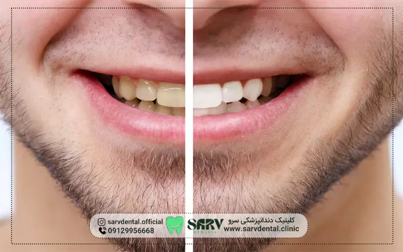 جلوگیری از آسیب بلیچینگ به مینای دندان