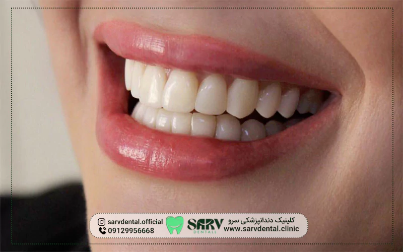 چگونگی تأثیر مواد بلیچینگ بر مینای دندان