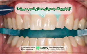 آیا بلیچینگ به مینای دندان آسیب می زند؟