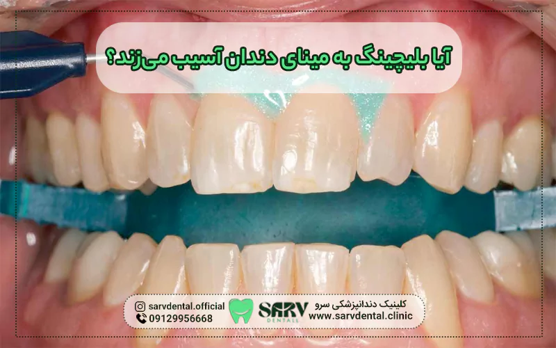 آیا بلیچینگ به مینای دندان آسیب می زند؟