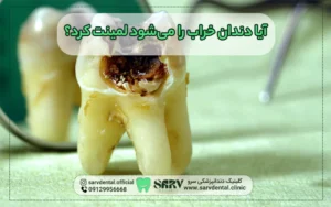 دندان خراب را می شود لمینت کرد؟