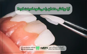آیا روکش دندان را می شود لمینت کرد؟