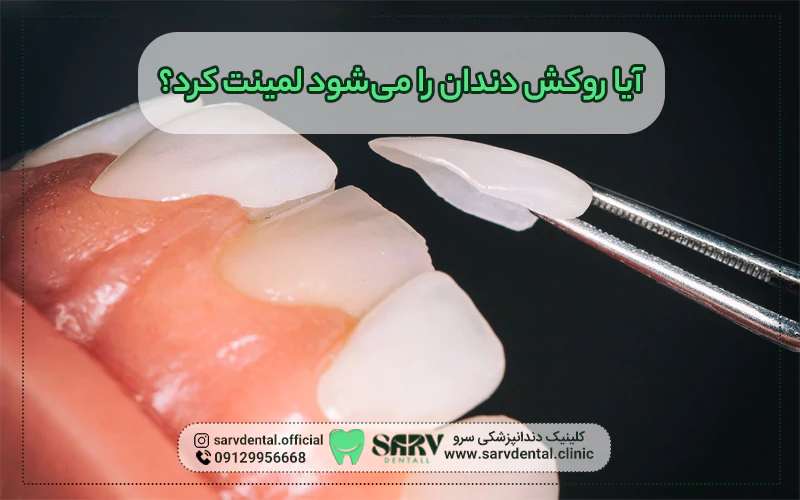 آیا روکش دندان را می شود لمینت کرد؟