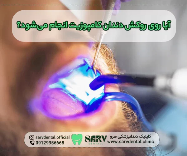 ایا روی روکش دندان کامپوزیت انجام می شود؟