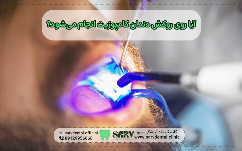 ایا روی روکش دندان کامپوزیت انجام می شود؟