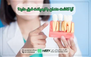 تفاوت کاشت دندان با ایمپلنت