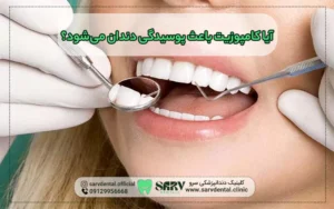 کامپوزیت باعث پوسیدگی دندان می شود؟