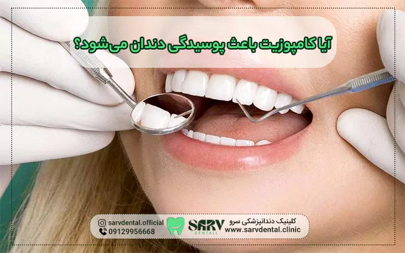 کامپوزیت باعث پوسیدگی دندان می شود؟