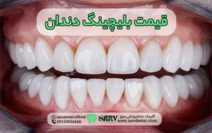 قیمت بلیچینگ دندان