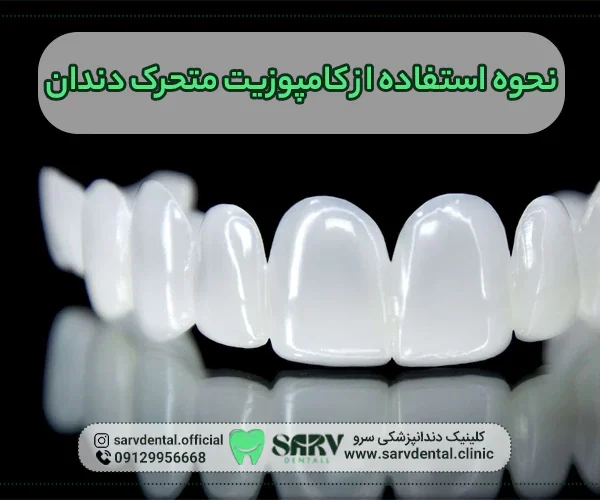 نحوه استفاده از کامپوزیت متحرک دندان