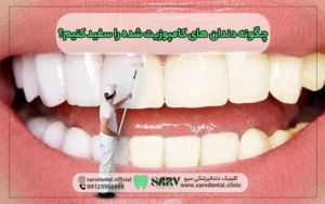 چگونه دندان های کامپوزیت شده را سفید کنیم؟