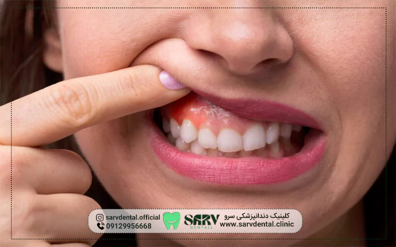 عفونت ایمپلنت چیست؟