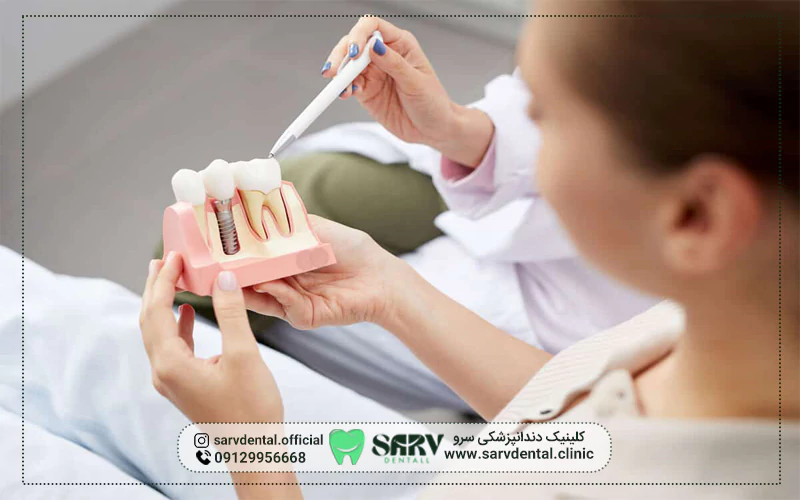 آیا بیمه تکمیلی هزینه ایمپلنت دندان را پوشش می‌دهد؟
