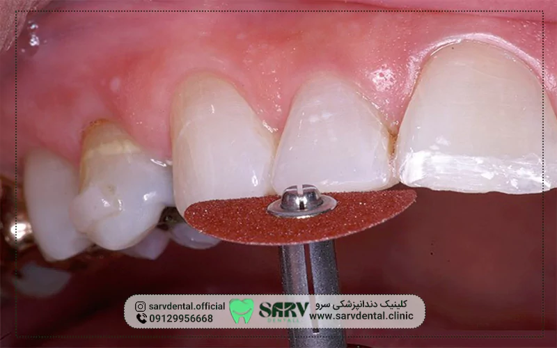 آیا تراشیدن دندان برای لمینت ضروری است؟