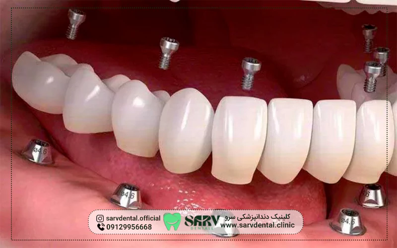 دندان مصنوعی ثابت با ایمپلنت چیست؟