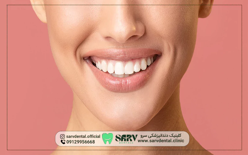 ویژگیهای کامپوزیت ونیر