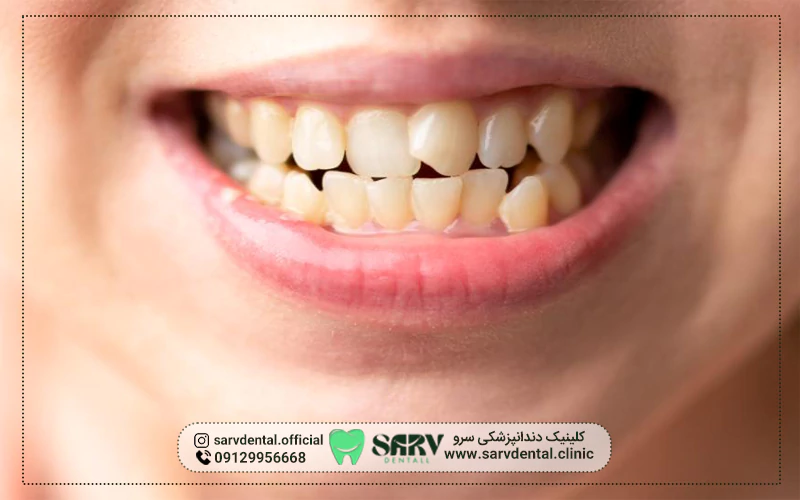 مزایای اصلاح دندان کج با کامپوزیت