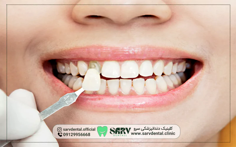 عوامل تاثیرگذار در استفاده از کامپوزیت روی ایمپلنت