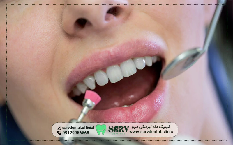 ویژگی‌های کامپوزیت خوب