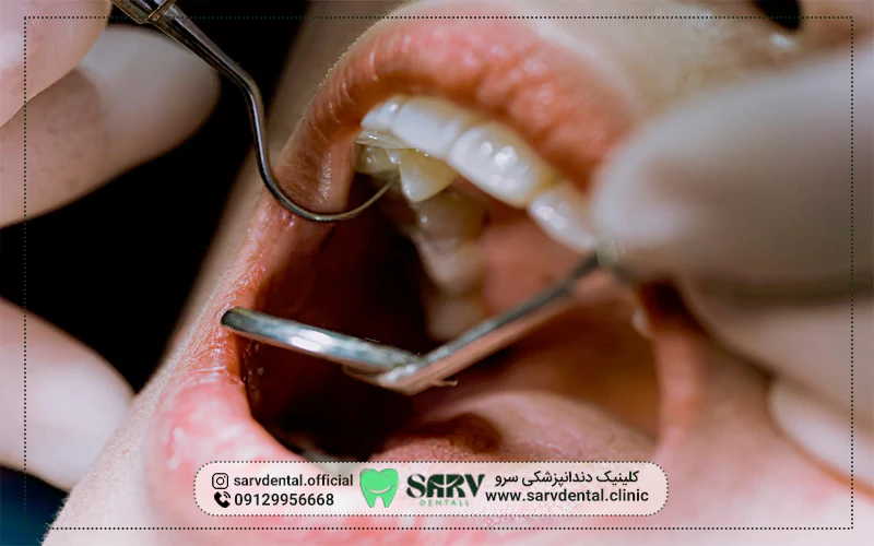 مزایای لمینت برای دندان عصب کشی شده