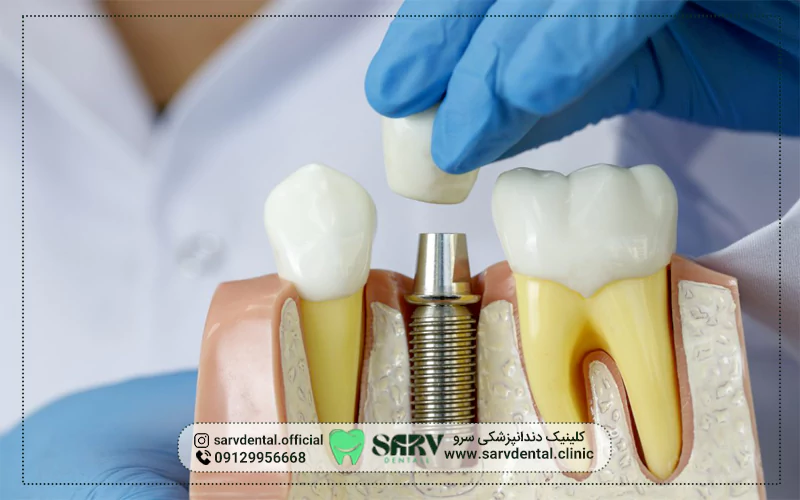 علائم نیاز به ایمپلنت دندان