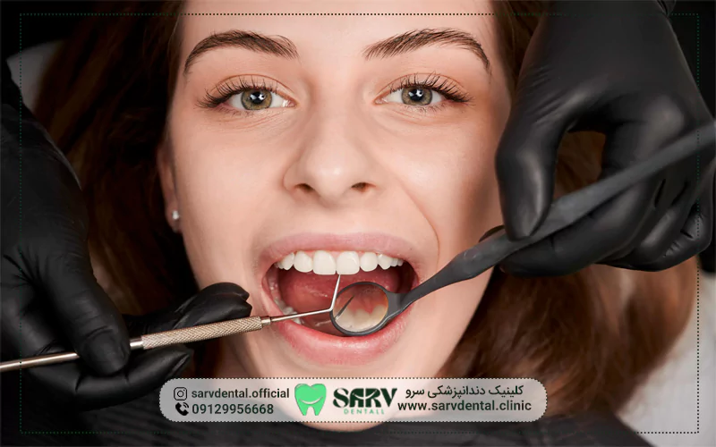 تعداد جلسات لازم برای کامپوزیت دندان