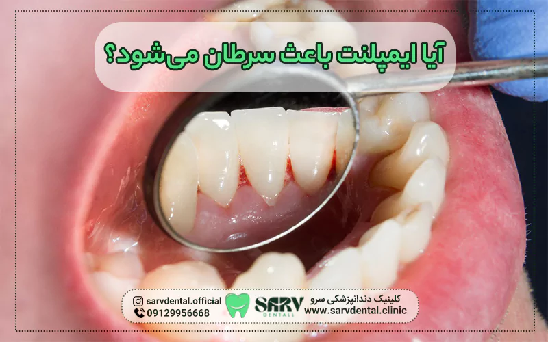 آیا ایمپلنت دندان باعث سرطان می‌ شود؟
