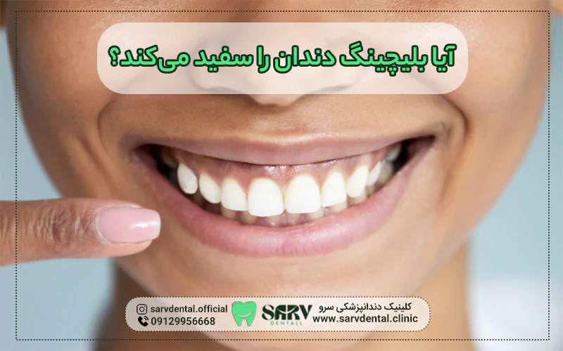 آیا بلیچینگ دندان را سفید می‌کند؟