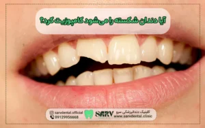دندان شکسته را می‌شود کامپوزیت کرد؟