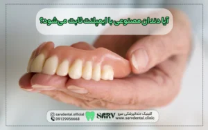 آیا دندان مصنوعی با ایمپلنت ثابت می‌شود؟