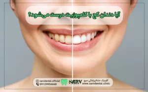 آیا دندان کج با کامپوزیت درست می‌شود؟