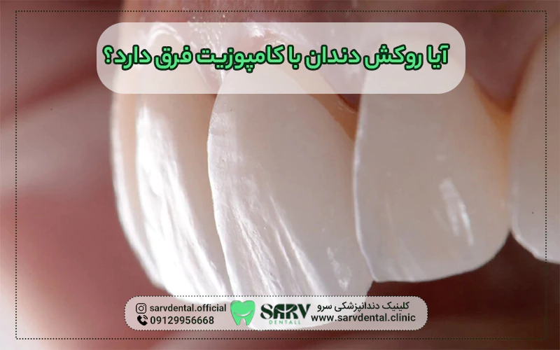 آیا روکش دندان با کامپوزیت فرق دارد؟