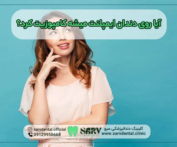 روی دندان ایمپلنت می شود کامپوزیت کرد؟