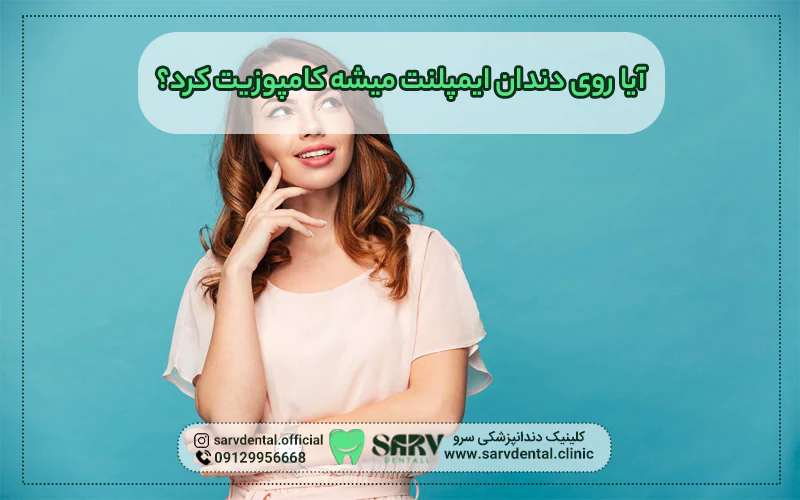 روی دندان ایمپلنت می شود کامپوزیت کرد؟