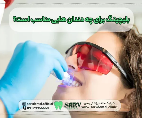 بلیچینگ برای چه دندان هایی مناسب است؟